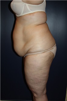 Body Contouring Before Photo by Larry Weinstein, MD; Chester, NJ - Case 42092