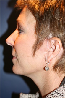 Facelift After Photo by Larry Weinstein, MD; Chester, NJ - Case 42093