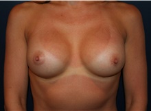 Breast Augmentation After Photo by Larry Weinstein, MD; Chester, NJ - Case 42107