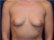 Breast Augmentation Before Photo by Larry Weinstein, MD; Chester, NJ - Case 42107