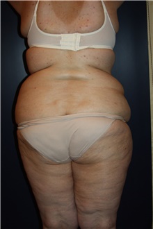 Liposuction Before Photo by Larry Weinstein, MD; Chester, NJ - Case 42556