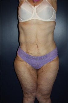 Liposuction After Photo by Larry Weinstein, MD; Chester, NJ - Case 42556