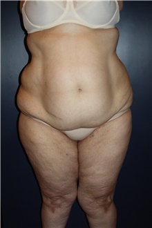 Liposuction Before Photo by Larry Weinstein, MD; Chester, NJ - Case 42556