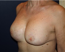 Breast Reconstruction After Photo by Larry Weinstein, MD; Chester, NJ - Case 42559