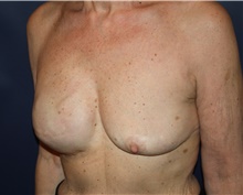 Breast Reconstruction Before Photo by Larry Weinstein, MD; Chester, NJ - Case 42559