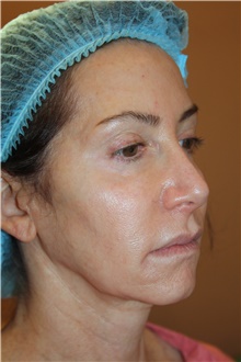 Facelift Before Photo by Larry Weinstein, MD; Chester, NJ - Case 42621