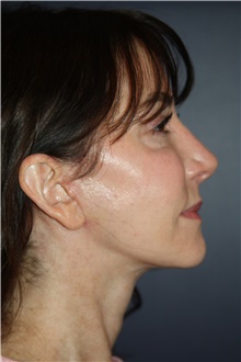 Neck Lift After Photo by Larry Weinstein, MD; Chester, NJ - Case 42622