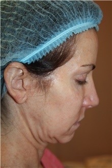 Neck Lift Before Photo by Larry Weinstein, MD; Chester, NJ - Case 42622