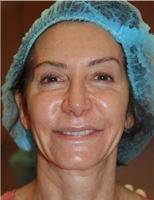 Eyelid Surgery Before Photo by Larry Weinstein, MD; Chester, NJ - Case 42623