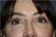 Eyelid Surgery After Photo by Larry Weinstein, MD; Chester, NJ - Case 42623