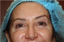 Eyelid Surgery Before Photo by Larry Weinstein, MD; Chester, NJ - Case 42623