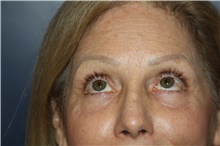 Eyelid Surgery After Photo by Larry Weinstein, MD; Chester, NJ - Case 42624