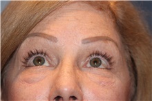 Eyelid Surgery Before Photo by Larry Weinstein, MD; Chester, NJ - Case 42624