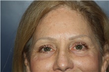 Eyelid Surgery After Photo by Larry Weinstein, MD; Chester, NJ - Case 42624
