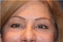 Eyelid Surgery Before Photo by Larry Weinstein, MD; Chester, NJ - Case 42624