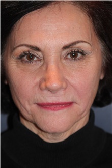 Facelift Before Photo by Larry Weinstein, MD; Chester, NJ - Case 42625