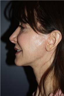 Neck Lift After Photo by Larry Weinstein, MD; Chester, NJ - Case 42627