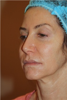 Facelift Before Photo by Larry Weinstein, MD; Chester, NJ - Case 42628