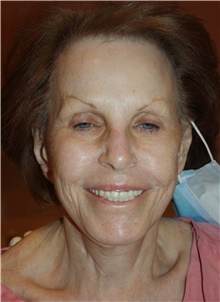 Facelift Before Photo by Larry Weinstein, MD; Chester, NJ - Case 42739