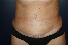 Tummy Tuck After Photo by Larry Weinstein, MD; Chester, NJ - Case 42747