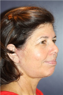 Facelift After Photo by Larry Weinstein, MD; Chester, NJ - Case 42750