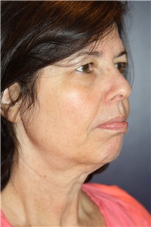 Facelift Before Photo by Larry Weinstein, MD; Chester, NJ - Case 42750