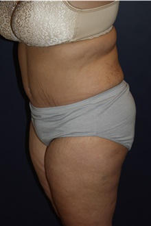 Tummy Tuck After Photo by Larry Weinstein, MD; Chester, NJ - Case 43425