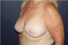 Breast Reconstruction After Photo by Larry Weinstein, MD; Chester, NJ - Case 44019