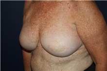 Breast Reconstruction Before Photo by Larry Weinstein, MD; Chester, NJ - Case 44019