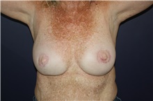 Breast Reconstruction After Photo by Larry Weinstein, MD; Chester, NJ - Case 44019