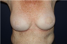 Breast Reconstruction Before Photo by Larry Weinstein, MD; Chester, NJ - Case 44019
