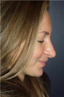 Facelift After Photo by Larry Weinstein, MD; Chester, NJ - Case 44024