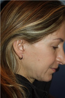 Facelift Before Photo by Larry Weinstein, MD; Chester, NJ - Case 44024