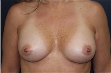 Breast Augmentation After Photo by Larry Weinstein, MD; Chester, NJ - Case 44312