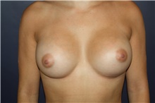 Breast Augmentation After Photo by Larry Weinstein, MD; Chester, NJ - Case 44995