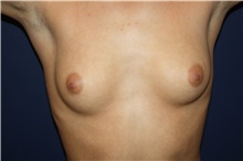 Breast Augmentation Before Photo by Larry Weinstein, MD; Chester, NJ - Case 44995