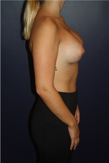 Breast Augmentation After Photo by Larry Weinstein, MD; Chester, NJ - Case 44995