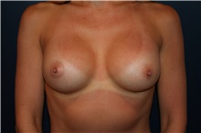 Breast Augmentation After Photo by Larry Weinstein, MD; Chester, NJ - Case 44996