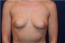 Breast Augmentation Before Photo by Larry Weinstein, MD; Chester, NJ - Case 44996