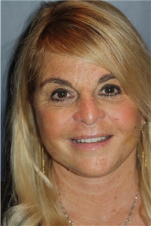 Facelift After Photo by Larry Weinstein, MD; Chester, NJ - Case 45440