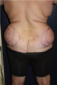 Liposuction Before Photo by Larry Weinstein, MD; Chester, NJ - Case 45521
