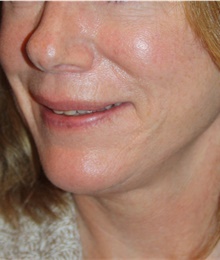 Facelift After Photo by Larry Weinstein, MD; Chester, NJ - Case 45522