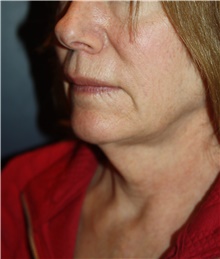 Facelift Before Photo by Larry Weinstein, MD; Chester, NJ - Case 45522