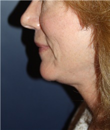 Neck Lift After Photo by Larry Weinstein, MD; Chester, NJ - Case 45523