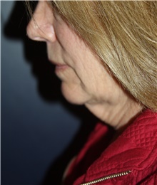 Neck Lift Before Photo by Larry Weinstein, MD; Chester, NJ - Case 45523