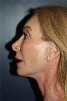 Facelift After Photo by Larry Weinstein, MD; Chester, NJ - Case 45752