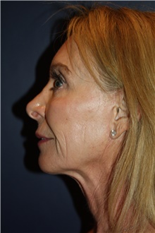 Facelift Before Photo by Larry Weinstein, MD; Chester, NJ - Case 45752