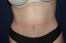 Tummy Tuck After Photo by Larry Weinstein, MD; Chester, NJ - Case 45839