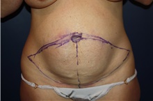Tummy Tuck Before Photo by Larry Weinstein, MD; Chester, NJ - Case 45839