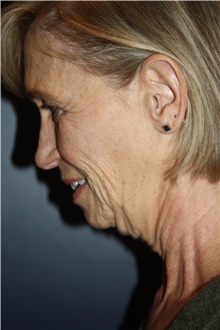 Facelift Before Photo by Larry Weinstein, MD; Chester, NJ - Case 45840